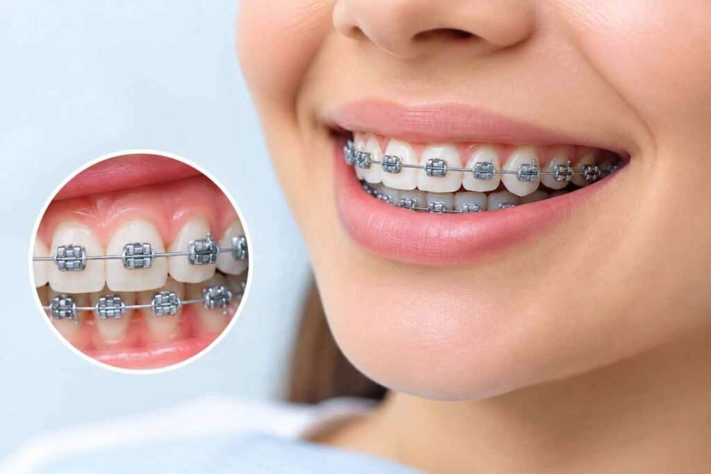 braces treatment in kalyani nagar